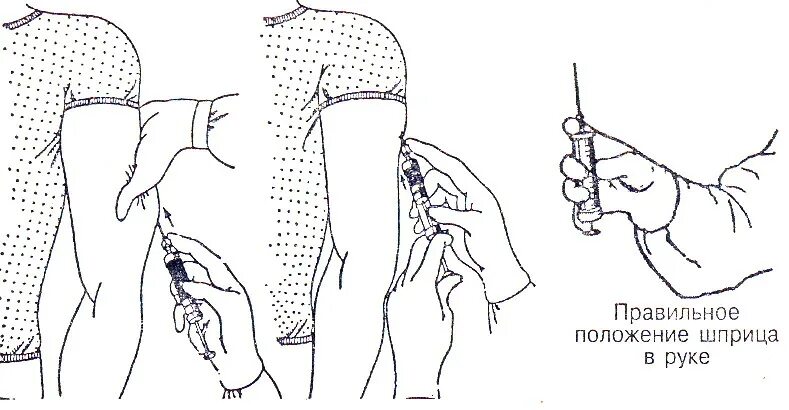 Как держать иглу. Подкожно инъекция алгоритм. Подкожная инъекция в плечо техника. Схема подкожного введения уколов. Техника постановки подкожной инъекции в плечо.