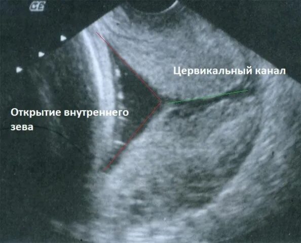 Истмико-цервикальная недостаточность на УЗИ. Внутреннего зева при беременности. УЗИ цервикометрия при беременности. УЗИ шейки матки цервикометрия. Матка 25 мм