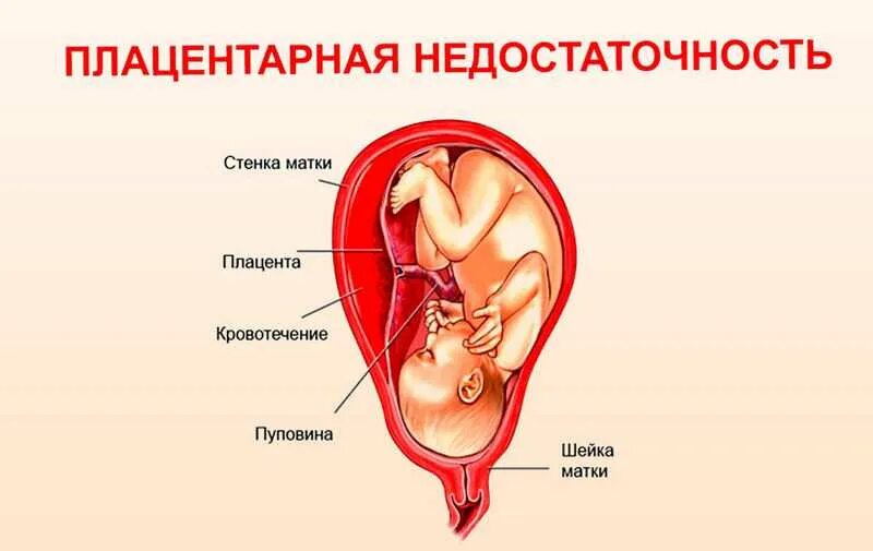 Плацентарная недостаточность при беременности 3 триместр. Плацента с признаками плацентарной недостаточности. Вторичная плацентарная недостаточность. Многообразная акушерская патология недостаточность плаценты. Плацента на рубце матки