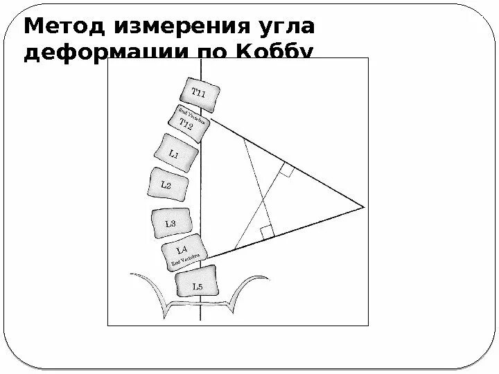 Измерение угла сколиоза по коббу. Метод Кобба сколиоз степени. Классификация сколиоза по коббу рентген. Угол Кобба степени сколиоза. Угол кобба