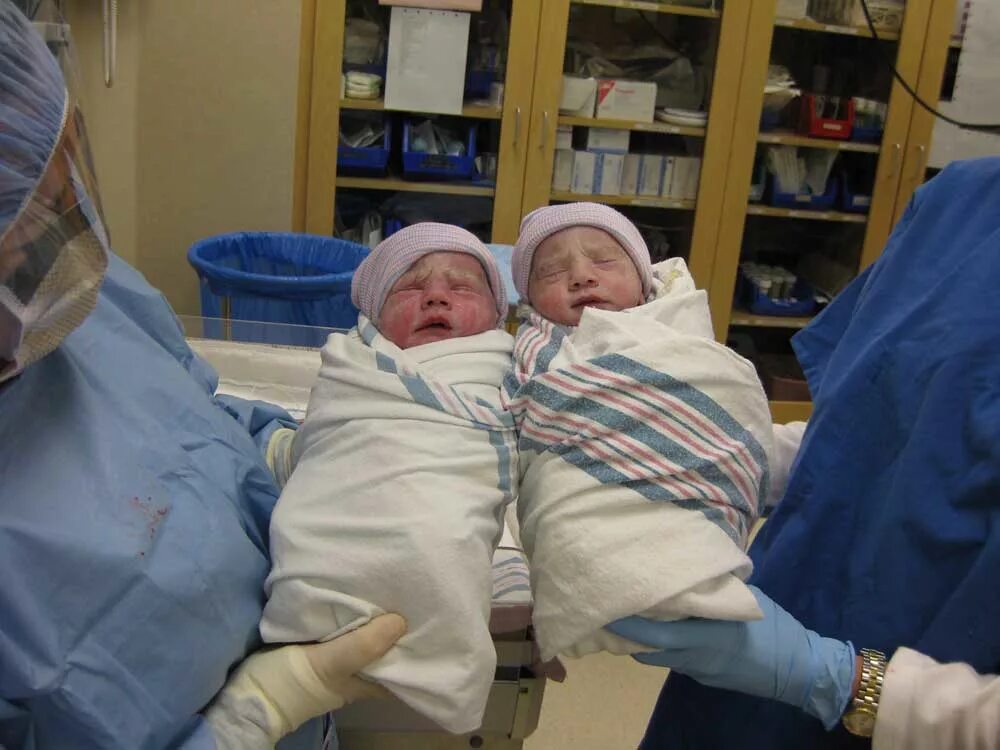 Двойня 24 недели. Расположение близнецов. Двойняшки беременность.