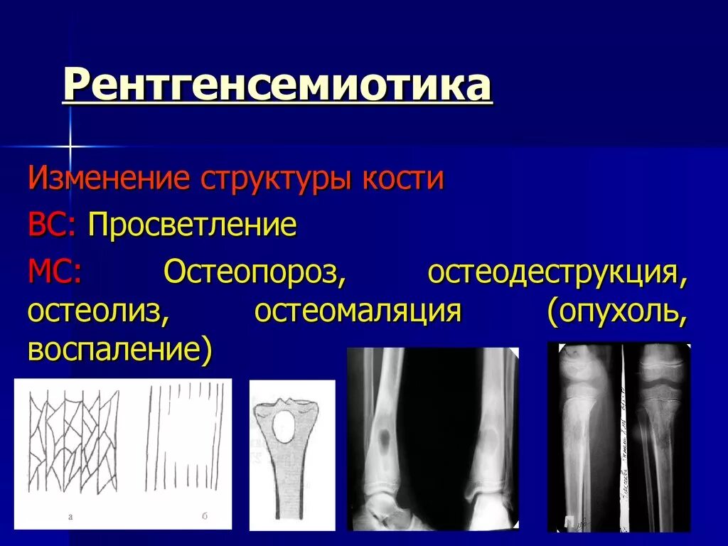 Остеодеструкция костей что это. Остеодеструкция лучевой кости. Изменение структуры кости