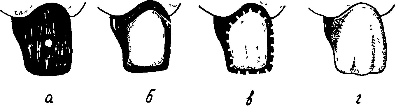 Коронка по Белкину препарирование. Комбинированная штампованная коронка по Белкину. Препарирование зуба под комбинированные коронки по Белкину. Штампованная коронка клинико лабораторные этапы. Штампованная коронка лабораторные этапы