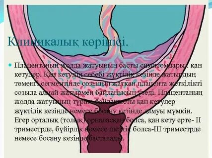 Жүктілік кезінде кіндіктегі қан ағымының бұзылуы