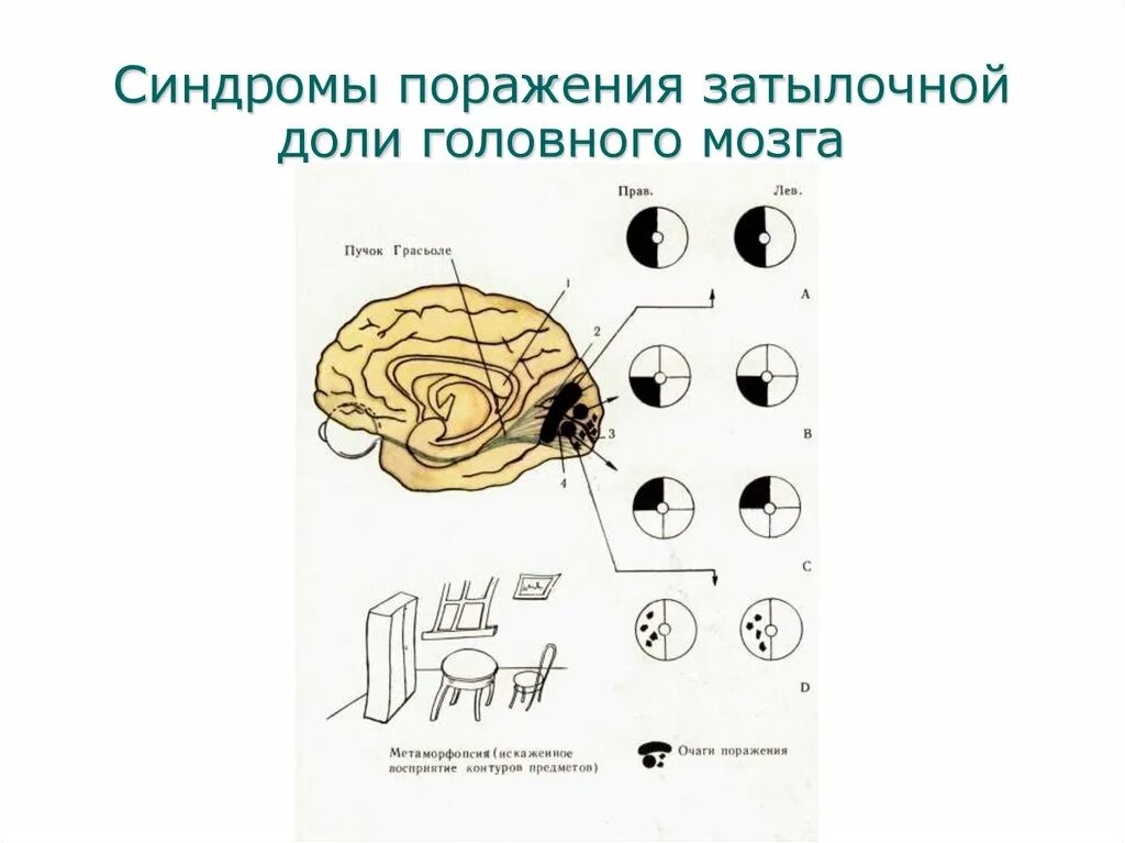 Синдромы поражения лобной доли. Синдромы поражения лобной и затылочной. Поражение лобной доли неврология. Для поражения лобной доли доминантного полушария характерно. Локализация психических функций в мозге