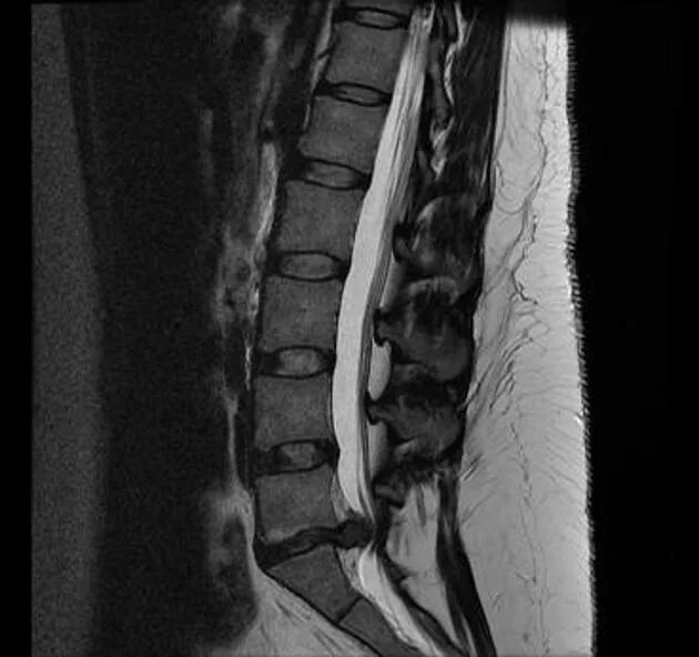 Грыжа l5 s1 конский хвост. Мрт позвоночника пояснично-крестцового отдела (l1-s1). Сдавление Корешков конского хвоста. Синдром компрессии l5 s1 корешка. Опухоль в поясничном отделе