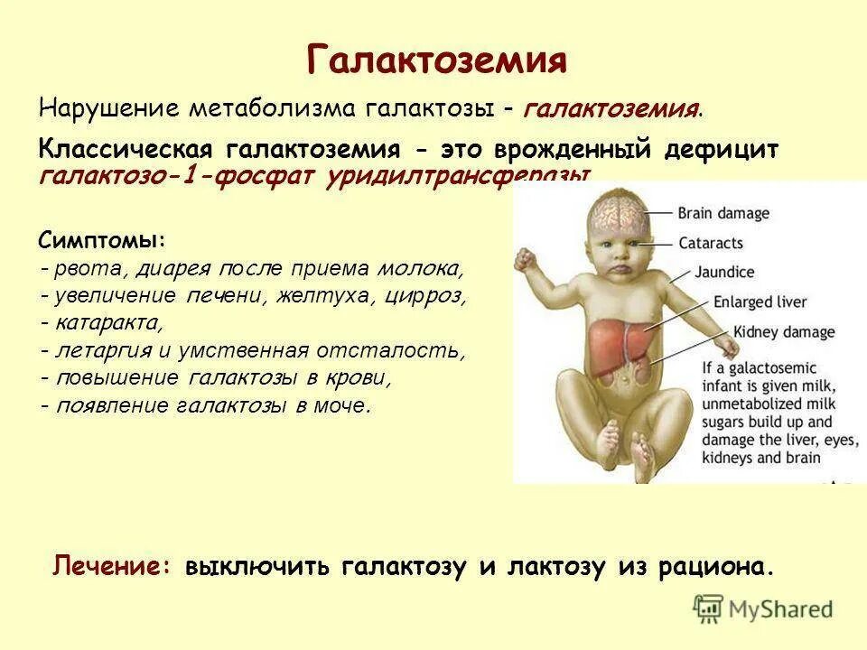 Галактоземия характерные признаки. Клинические симптомы галактоземии. Галактоземия основные клинические проявления. Тип наследования болезни галактоземия.