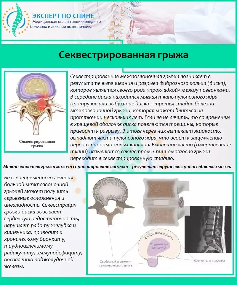 Секвестрированная грыжа диска. Секвестирование грыжи диска. Грыжа пояснично-крестцового отдела секвестрированная. Секвестрированная грыжа межпозвоночного диска.