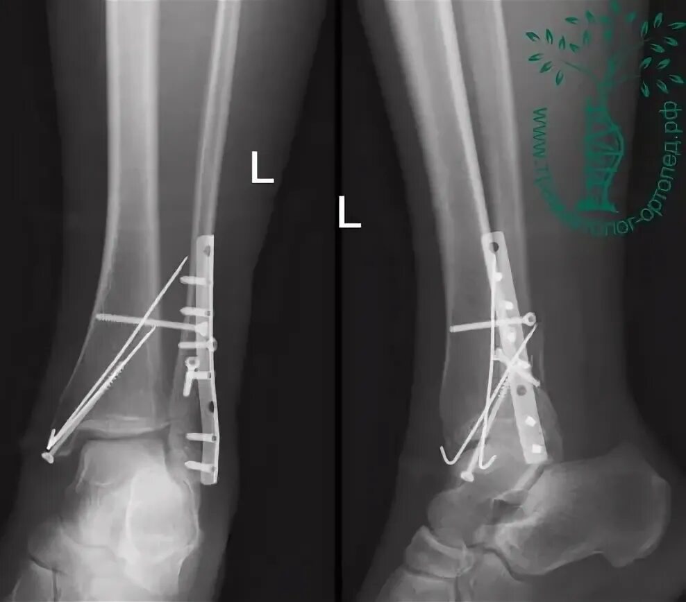 Перелом лодыжки форум вумен. Перелом латеральной лодыжки большеберцовой кости. Перелом медиальной лодыжки большеберцовой кости. Апикальный перелом лодыжки. Остеосинтез наружной лодыжки.