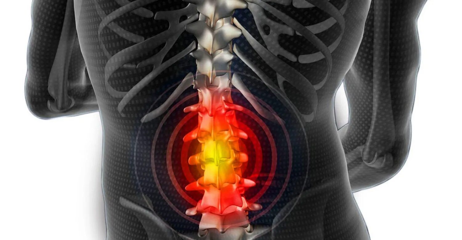 Сильные боли грыжа позвоночника. Межпозвоночная грыжа. Спинная грыжа.
