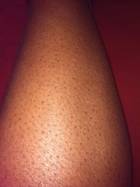 Bikini Line - Laser Hair Removal Results shown after 3 tre. Flickr