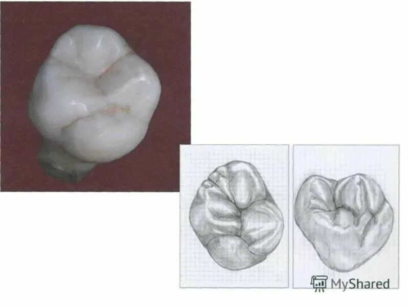 Анатомия зубов 1 моляра нижней челюсти. Анатомия верхнего моляра. 1 моляр верхней челюсти анатомия. Моляр верхней челюсти три корня. Первый моляр верхней челюсти анатомия.