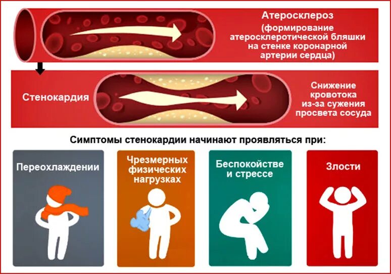 Стенокардия симптомы. Симптомы стенокардии сердца. Грудная жаба симптомы.