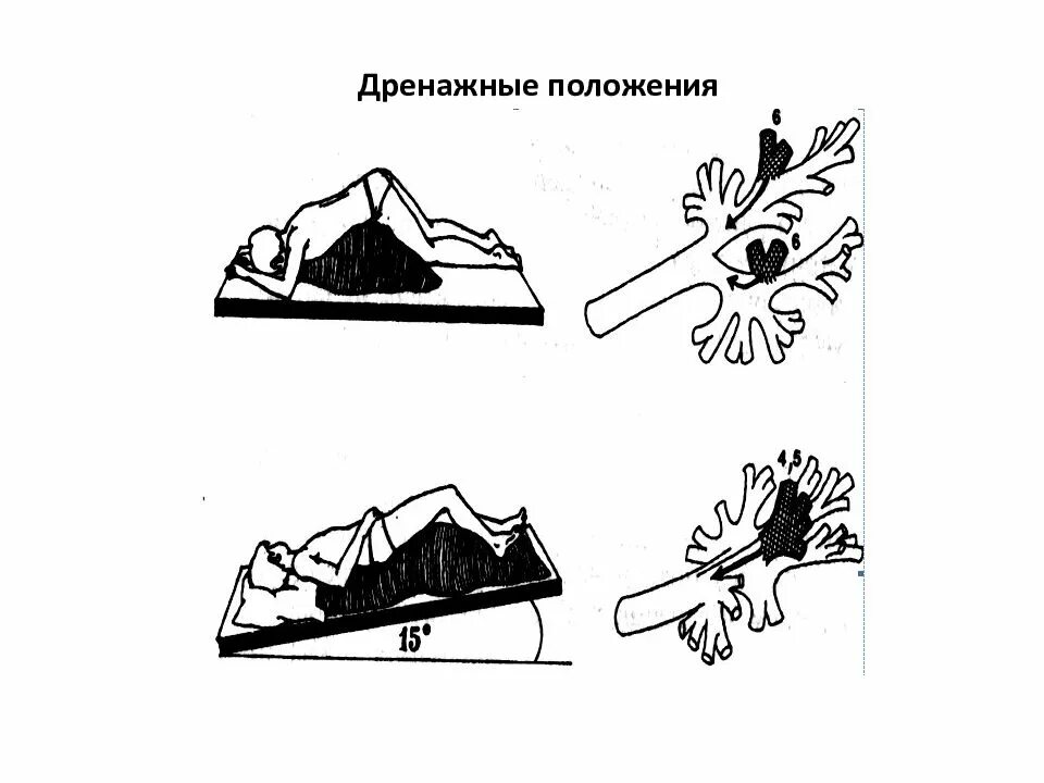 Дренажное положение. Дренажные положения для отхождения мокроты. положение квинке для отхождения мокроты. постуральный дренаж положение квинке. дренажное положение при бронхоэктатической болезни.