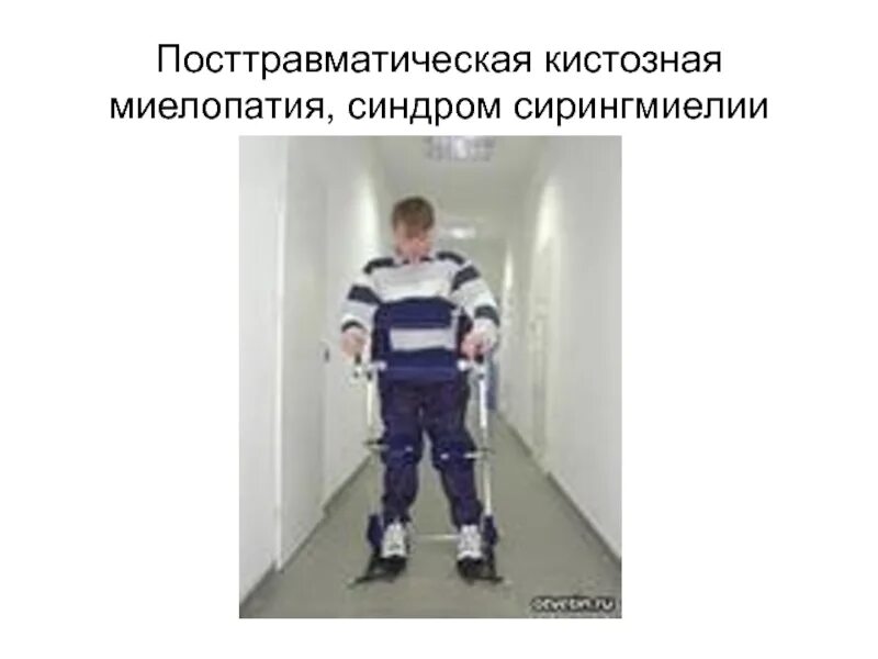 Люди с рс. Рассеянный склероз. люди с рассеянным склерозом. рассеянный склероз фото больных. фото людей с рассеянным склерозом.