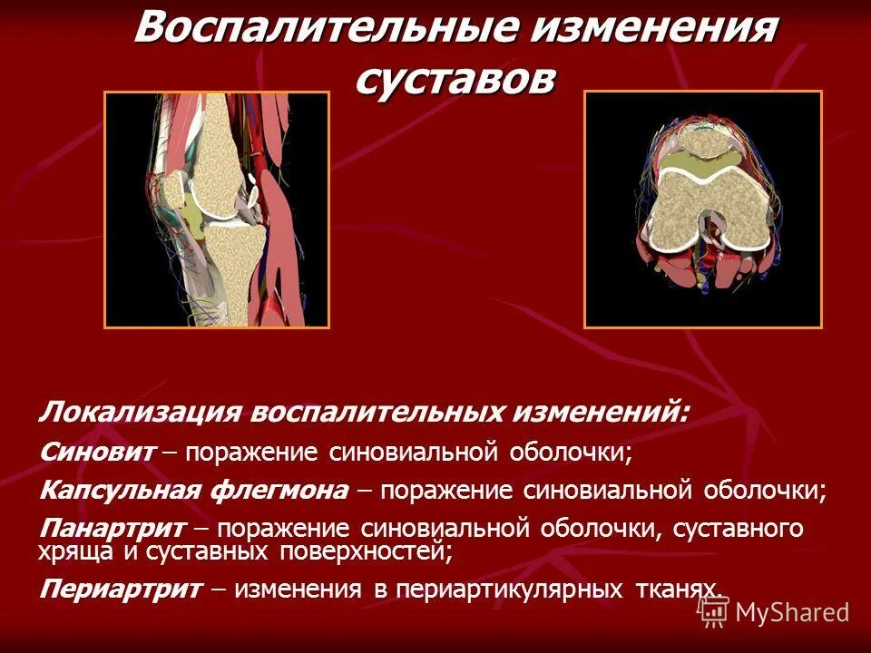 Изменение формы сустава. Воспалительные изменения в суставах. Воспалительные поражения суставов. Поражение синовиальной оболочки. Эксудативные изменение суставов.