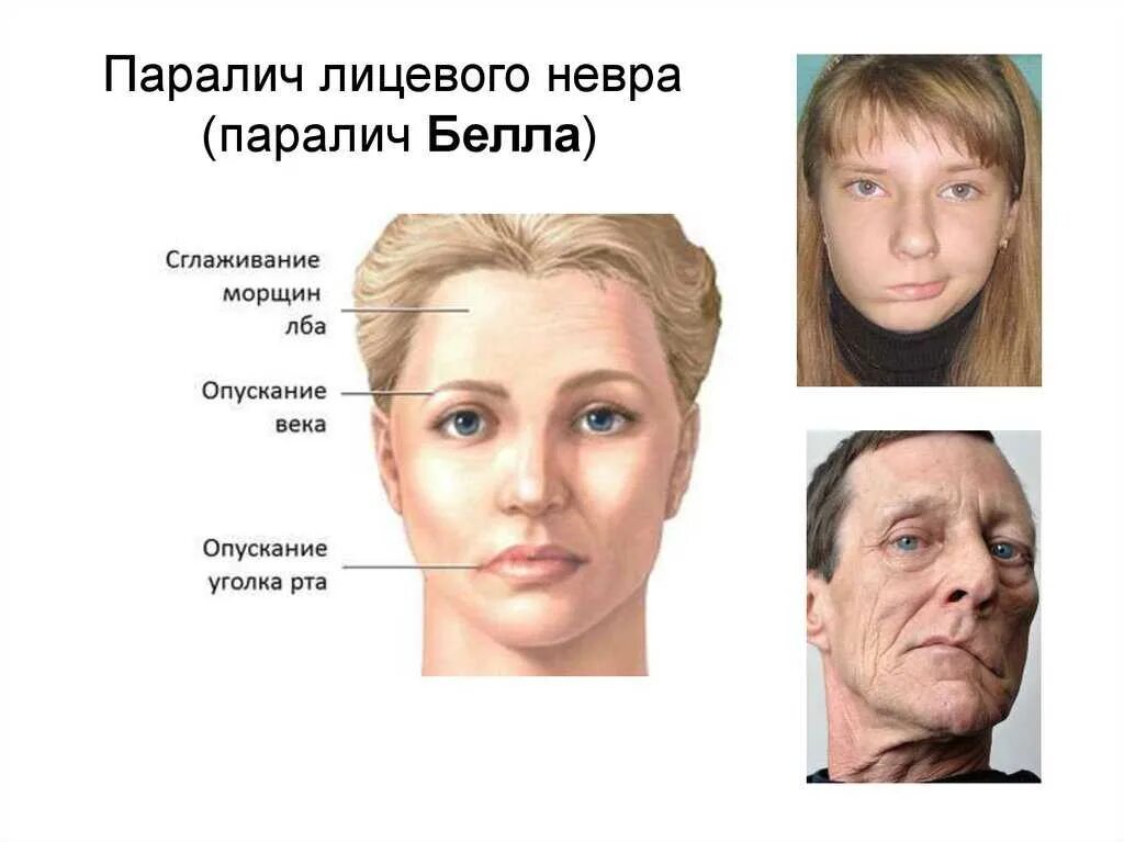 Нарушение формирования лица. Паралич белла центральный и периферический. парез лицевого нерва паралич белла. левосторонняя прозопалгия лица. воспаление лицевого нерва парез белла.