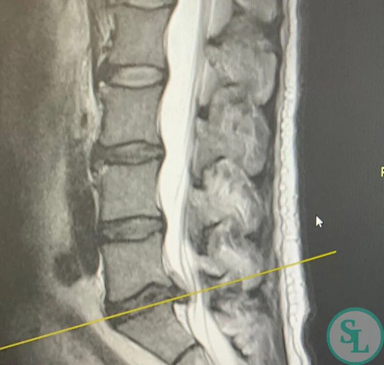 L4 l5 отдел позвоночника протрузия. Секвестральная грыжа l5 s1. Грыжа l5-s1. Секвестрированная грыжа l5-s1. Грыжа l5-s1 паралич.
