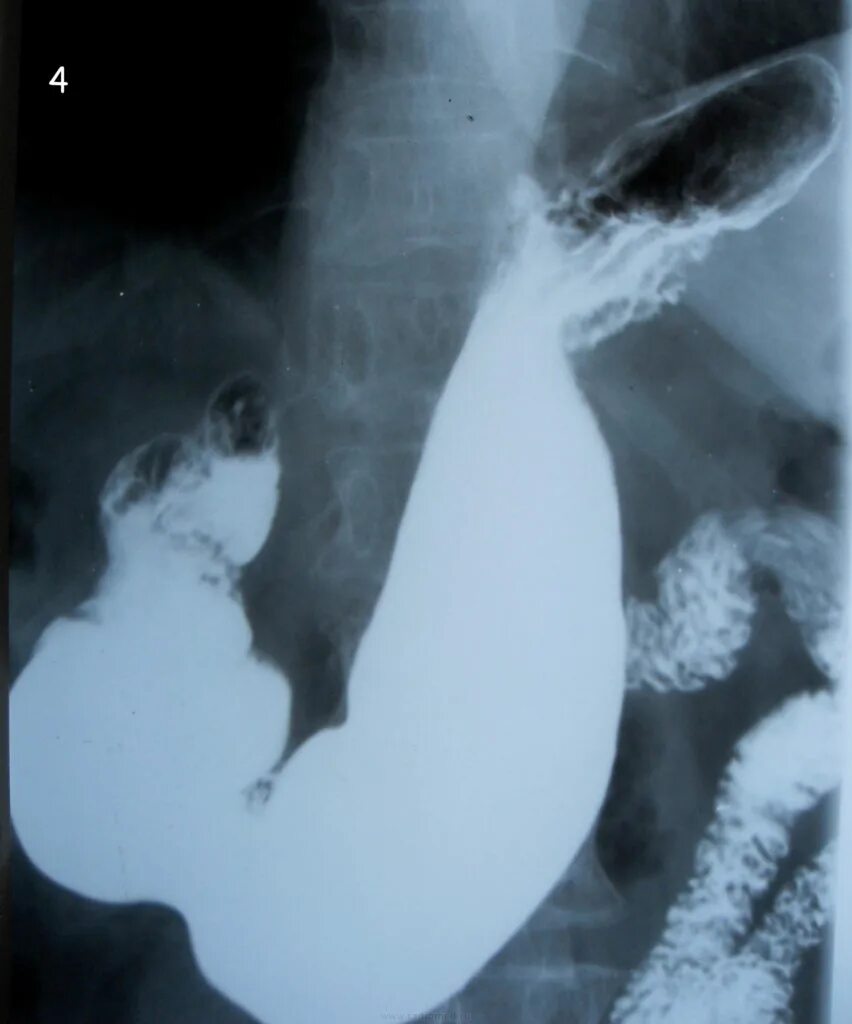 Пищевода с барием. Скопия желудка рентген. Рентген желудка и 12 перстной кишки с контрастом. Скопия желудка с барием. Рентген исследование желудка с барием.