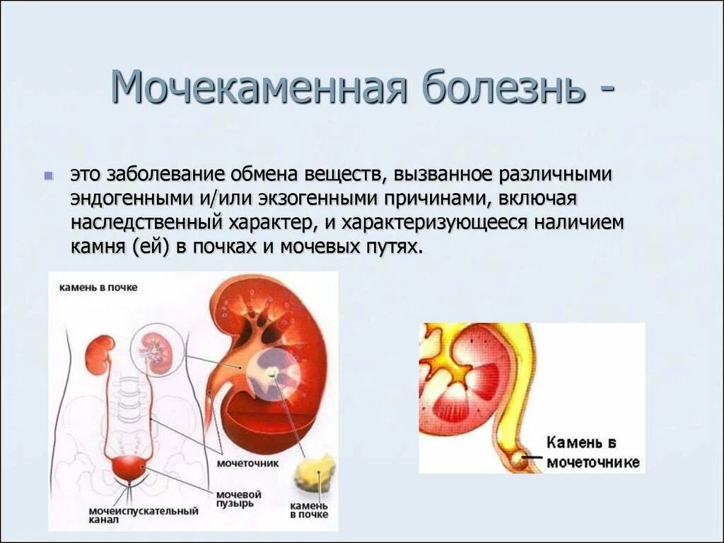 Может ли болеть одна почка. Заболевания мочевыделительной системы мочекаменная болезнь. Заболевание почек мочекаменная болезнь симптомы. Мочекаменная болезнь (urolithiasis). Моче-КАМНЕННАЯ болезнь.