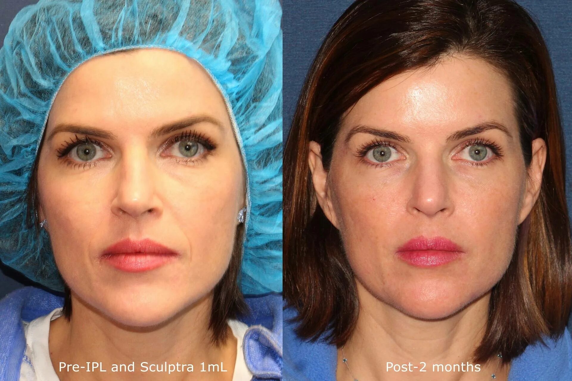 Sculptra полимолочная кислота. уколы скульптра до и после. скульптра sculptra. Sculptra до и после. скульптра до и после.