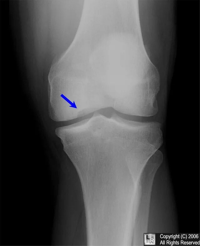 Остеохондропатия оссого Шлеттер. Остеохондроз коленного сустава рентген. Остеохондрит коленного сустава. Остеохондропатия коленного сустава рентген.