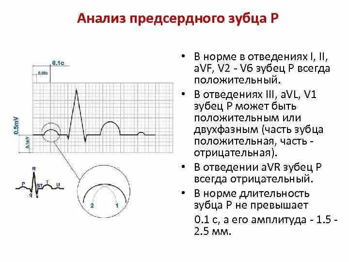 Острые зубцы на экг. Зубец p на экг v1. отрицательный зубец p в v1 v2 отведении. отрицательный зубец р в 1 отведении. v1 экг деформирован отрицательный зубец.