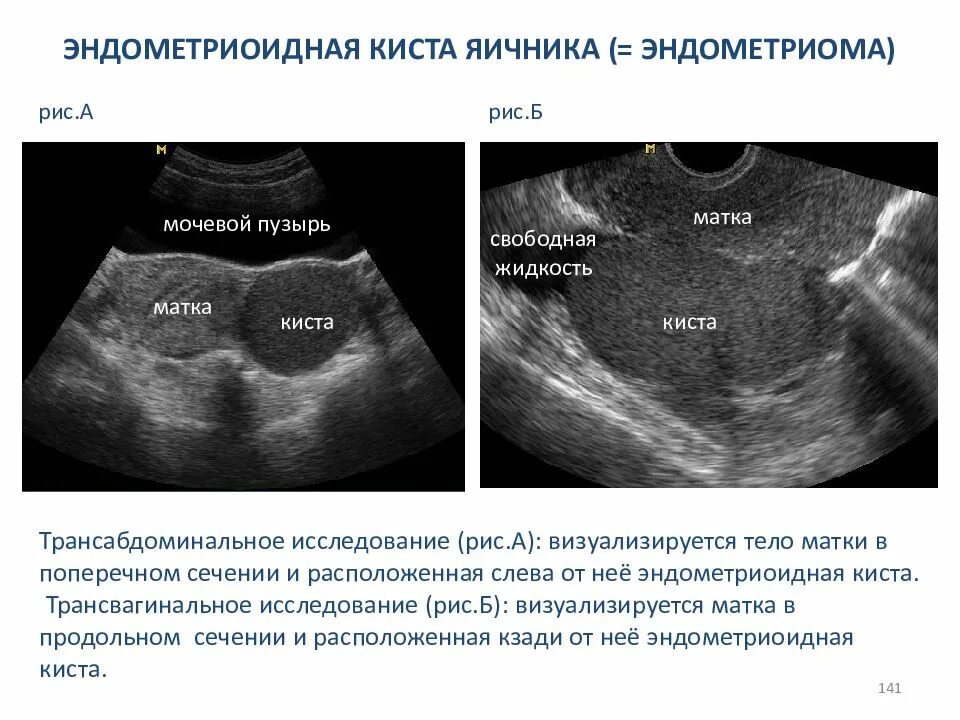 Шоколадная киста яичника УЗИ. Эндометриоидные кисты яичника на УЗИ. Киста правого яичника эндометриоидная на УЗИ. Удалить яичники при раке