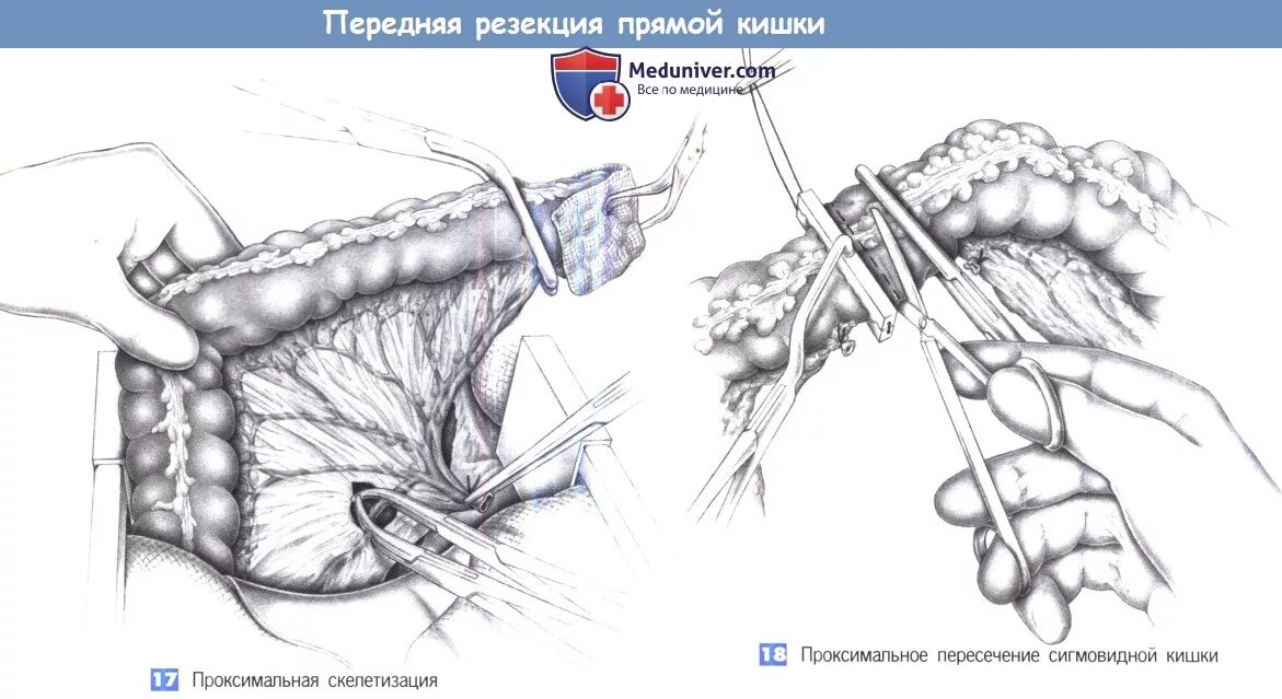 Лапароскопическая передняя резекция прямой кишки ход операции. Резекция сигмовидной и прямой кишки. Сфинктеросохраняющая резекция. Резекция толстой кишки лапароскопия. Операции через прямую кишку