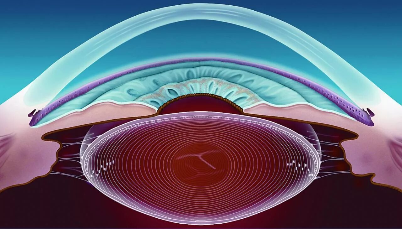 Строение глаза сетчатка роговица. Анатомия хрусталика офтальмология. Роговица сетчатка структура глаза. Катаракта схема глаза. Искусственная интраокулярная линза.