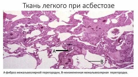 Асбестоз