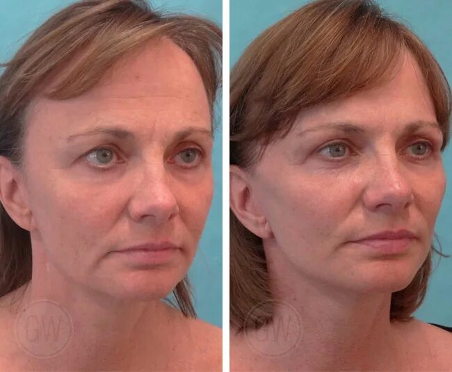 NYC Midtown Plastic Surgery Long Island Breast Implants Huntington Face lift sur