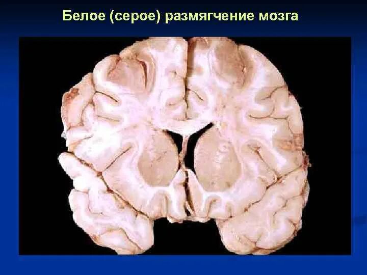 Размягчение головного мозга. Колликвационный некроз головного мозга. Ишемический инсульт мозг макропрепарат. Ишемический белый инфаркт головного мозга макропрепарат. Очаг серого размягчения головного мозга.