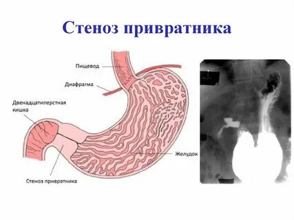 Функциональная недостаточность привратника