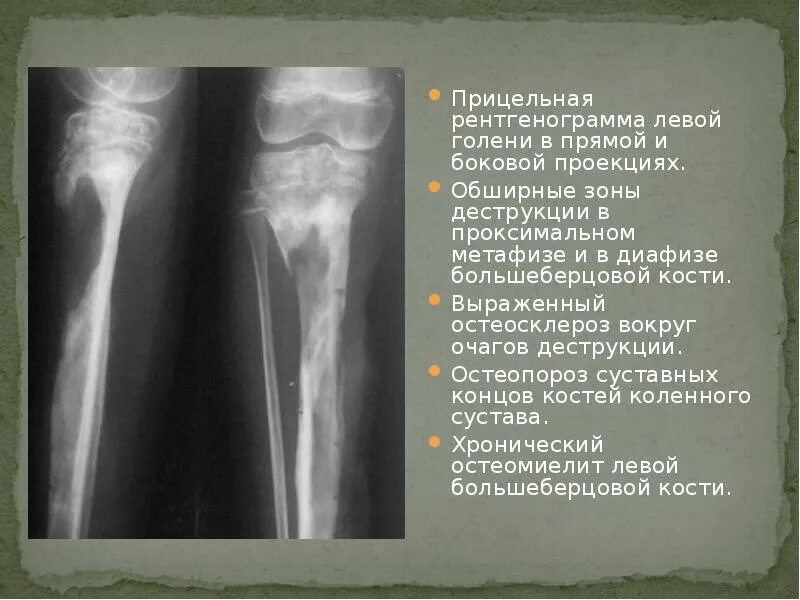 Остеосклероз рентген. Остеопорозный перелом. остеопороз перелом большеберцовой кости. остеосклероз голени рентген. деструкция большеберцовой кости рентген.
