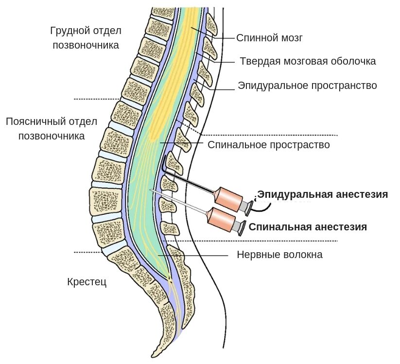 Боли в спине после эпидуральной. Эпидуральная анестезия строение спинного мозга. Люмбальная эпидуральная анестезия. Спинномозговая анестезия и эпидуральная анестезия отличия. Спинальная анестезия и эпидуральная анатомия.