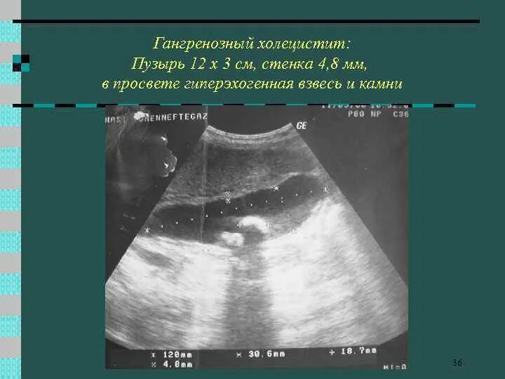 Эхогенный желчный пузырь. Гиперэхогенный желчный пузырь УЗИ. УЗИ желчного пузыря холецистит. Мелкодисперсная взвесь в желчном пузыре на УЗИ. Гангренозный холецистит.