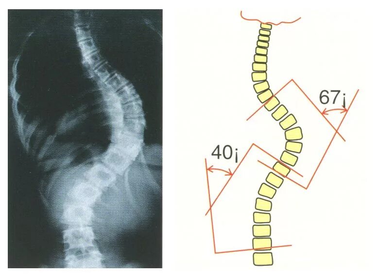 Искривление позвоночника градусы. Угол Кобба 1 степени сколиоза. Сколиоз кифоз 3 степени. Сколиоз 3 степени рентген. Сколиоз 4 степени рентген.