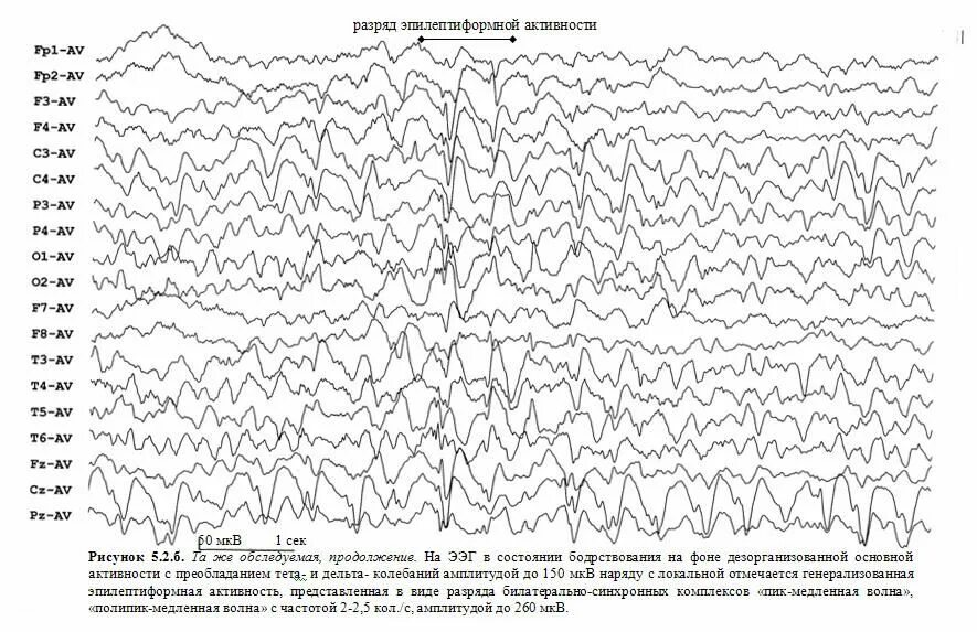 Активность ээг у ребенка что это. Эпилептические паттерны на ЭЭГ. ЭЭГ паттерн эпилепсии. Комплексы пик волна на ЭЭГ. Вертексные потенциалы на ЭЭГ.