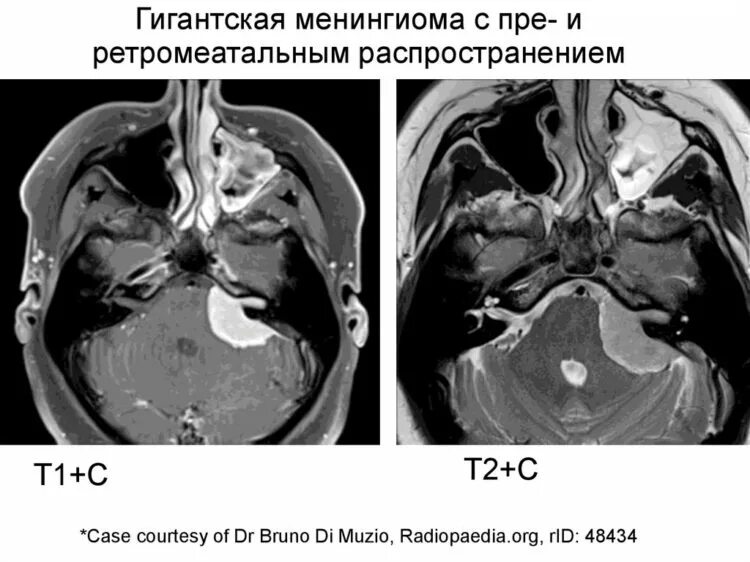 Менингиома мозжечка мрт. Менингиома мозжечка кт. Конвекситальная менингиома мрт. Менингиома намета мозжечка кт.