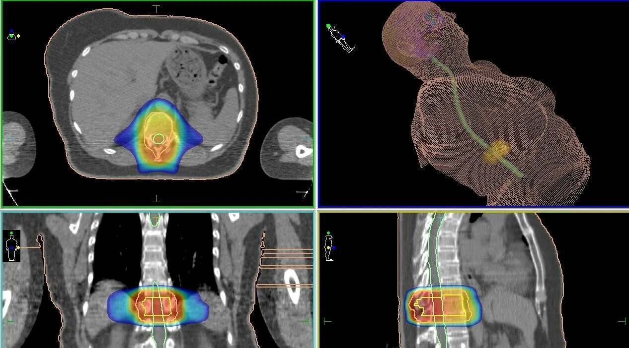 Метастазы в позвонок лучевая терапия. Метастазы в тела позвонков кт. Лучевая терапия при метастазах в позвоночнике. Метастазы в костях позвоночника на кт.