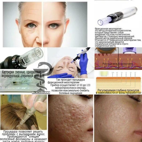 Фракционная мезотерапия для лица до и после Microneedling treatment for skin (DERMAPEN) FreyaEstetica