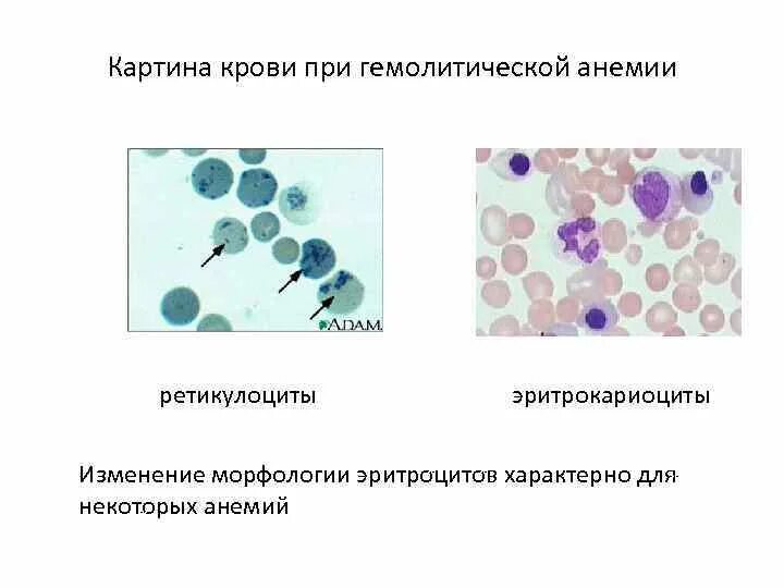 Ретикулоциты анализ крови анемия. Ретикулоциты при гемолитической анемии. Агрегатные ретикулоциты. Ретикулоциты 2.7.