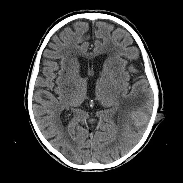 Компьютерная томография головного мозга норма. Кт томограмма головного мозга. Компьютерная томография кт головного мозга. Туберкулома головного мозга кт.