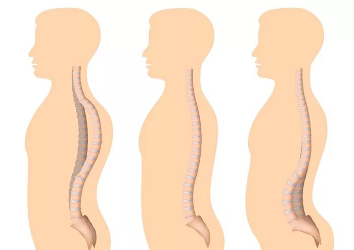 сколиоз позвоночника лфк упражнения. кифоз грудного отдела позвоночника упражнения. искривление позвоночника кифоз. гимнастика для кифоза грудного отдела позвоночника. искривление осанки кифоза.
