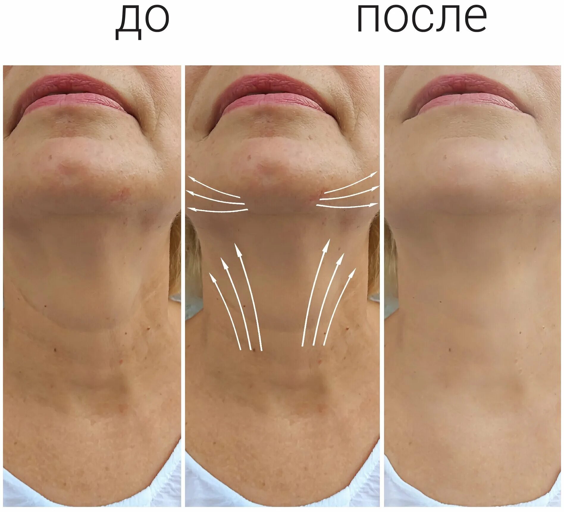 Профайло до и после отзывы Profhilo Body: The Latest Glow-Inducing Treatment 111 Harley St. Clinic.