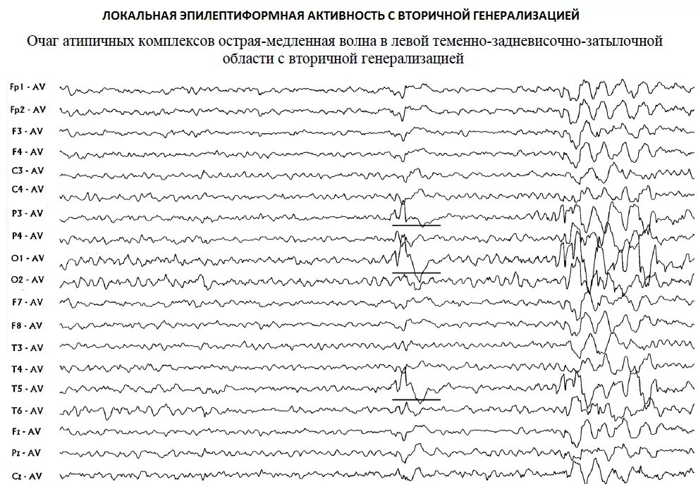 Эпилептиформные паттерны на ЭЭГ. Патологическая активность на ЭЭГ что это. Острые волны на ЭЭГ У взрослого. Полифазные волны на ЭЭГ.