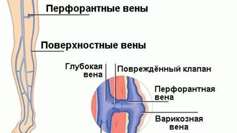 Клапанная недостаточность перфорантной вены Коккета. Вены перфоранты нижних конечностей. Перфорантная Вена в средней трети голени это. Перфорантные вены нижних конечностей недостаточность клапаны. Что значат вены на ногах