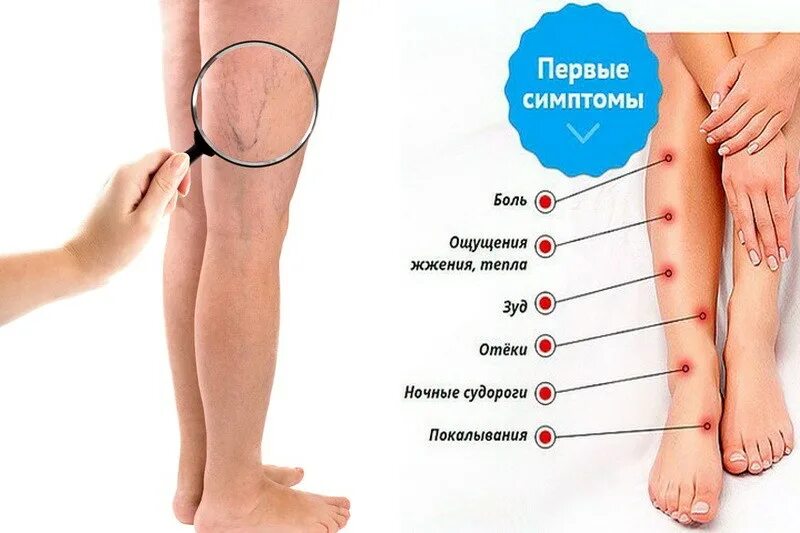 Припухлость и болезненность. Профилактика варикозного расширения вен. Расширение вен симптомы. Расширение вен на ногах симптомы.