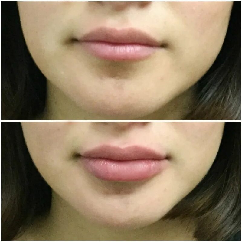 Увеличение губ lips. Увеличенные губы красивые.